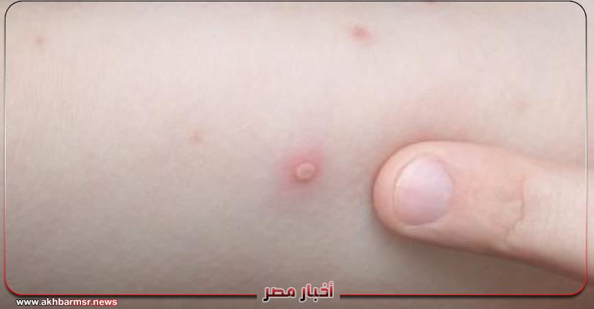 جدرى القرود