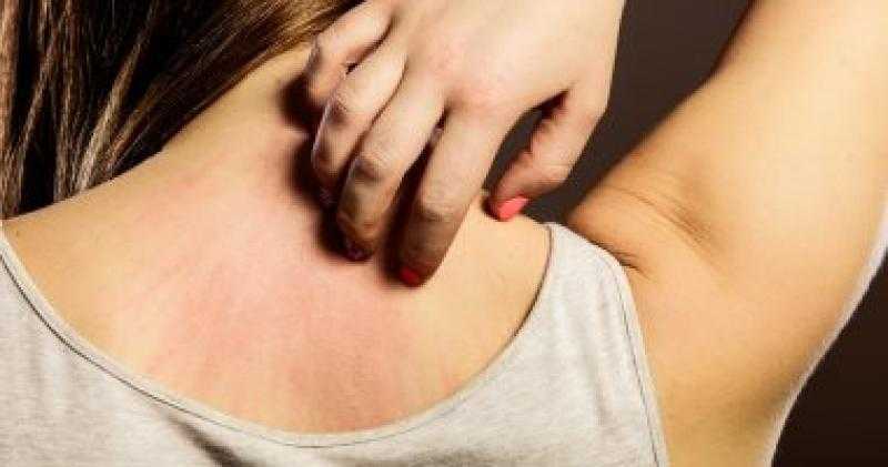 في الصيف.. لو بتعانى من الطفح الحراري جرب فوائد التبريد لزيت جوز الهند