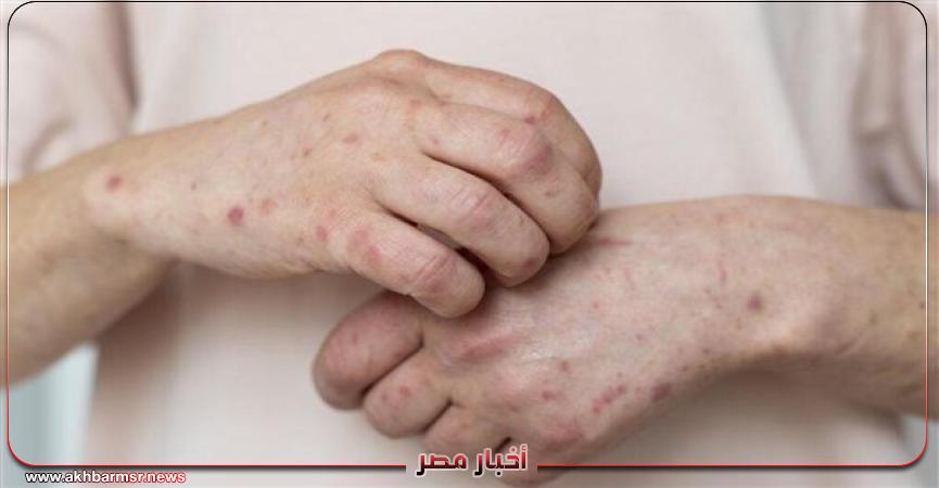 صحة وطب جدري القرود