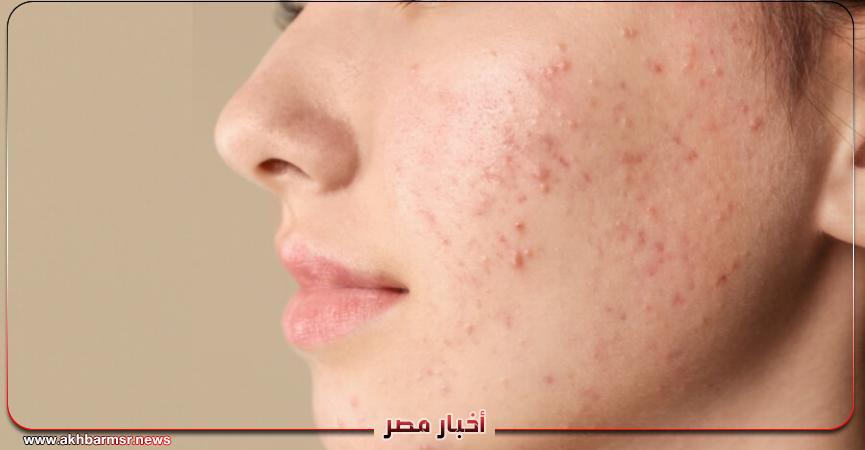 حب الشباب