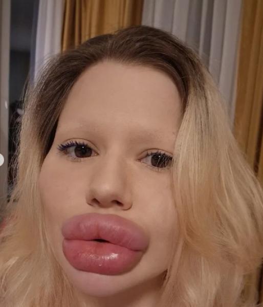 صاحبة أكبر شفاه في العالم تكشف عن شكلها قبل عمليات التجميل