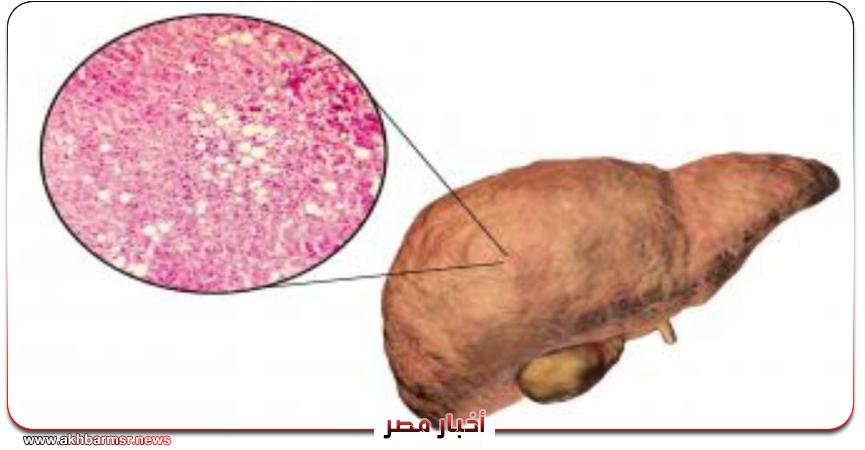 إنجاز طبي جديد.. «ويجوفي» يحصل على موافقة أمريكية لعلاج التهاب الكبد الدهني