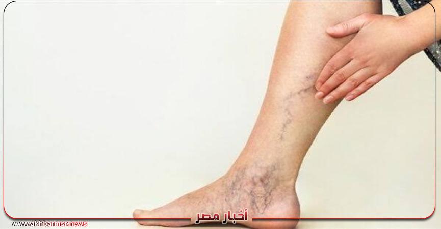  انتبه لصحة قدميك.. 6 إشارات خطيرة تكشف عن انسداد الشرايين