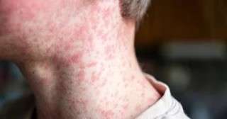 إعلام عبرى: رعب فى إسرائيل بعد انتقال عدوى مرضى الحصبة إلى الأطباء