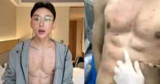 مؤثر صيني يدفع 560 ألف دولار لتكوين عضلات بطن وهمية باستخدام حقن... مؤثر صيني يدفع 560 ألف دولار لتكوين عضلات بطن وهمية باستخدام حقن الهيالورونيك