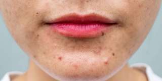 تنبيه عاجل: عادات خاطئة تزيد «حب الشباب» سوءًا تنبيه عاجل: عادات خاطئة تزيد «حب الشباب» سوءًا