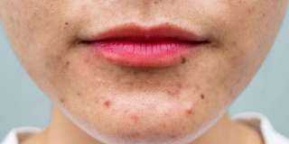 تنبيه عاجل: عادات خاطئة تزيد «حب الشباب» سوءًا تنبيه عاجل: عادات خاطئة تزيد «حب الشباب» سوءًا