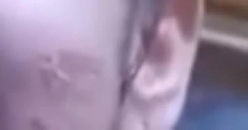 نقل حضانة الطفلة أسيل لجدتها من الأب بعد تعرضها للكوى بشوكة من والدتها